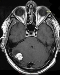 Guz hemangioblastoma naczyniak zarodkowy móżdżku